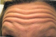 forehead-lines.jpg